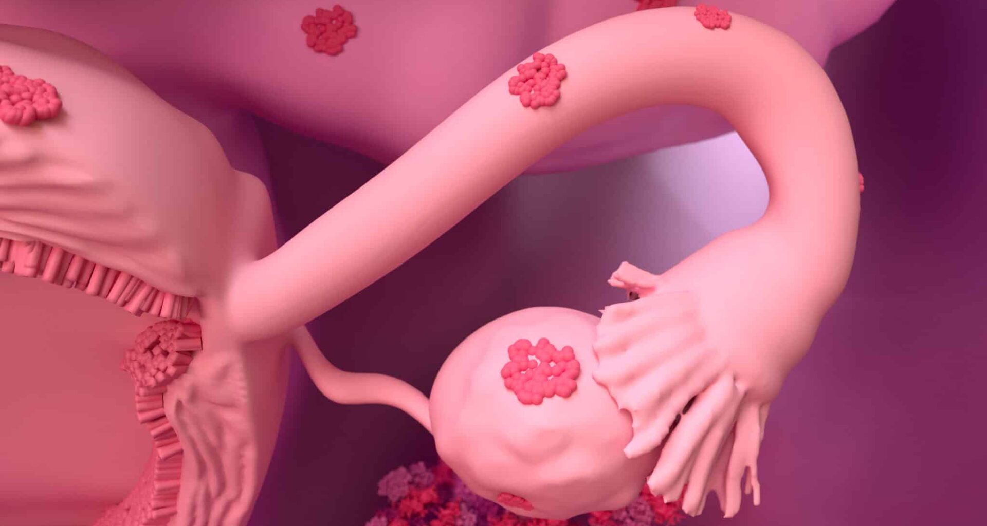 endométriose