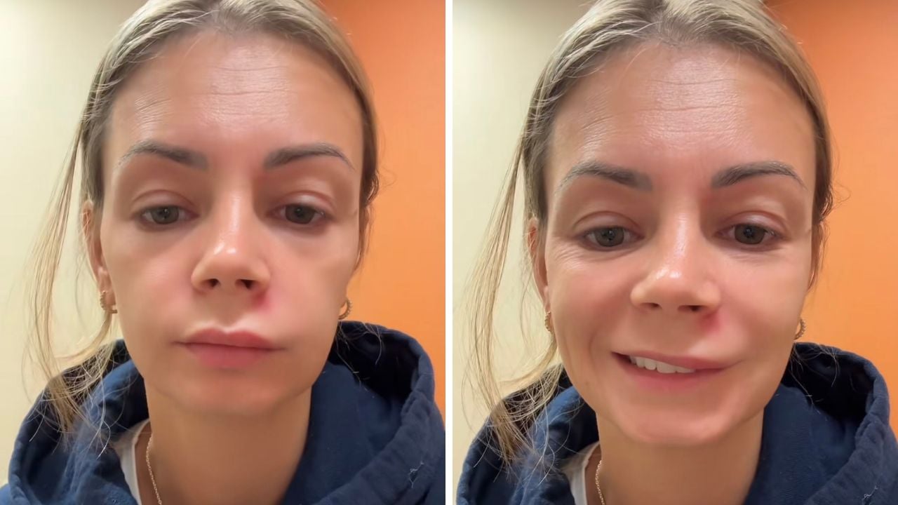 Elle finit aux urgences après s'être percé un bouton au niveau du "triangle de la mort", cette zone dangereuse du visage