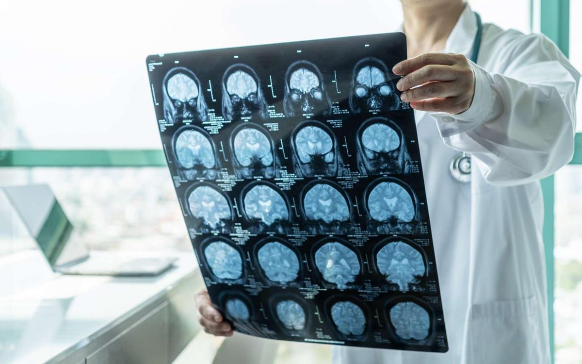 Qu’est-ce qui déclenche la maladie d’Alzheimer ? Une équipe de chercheurs a peut-être trouvé la réponse