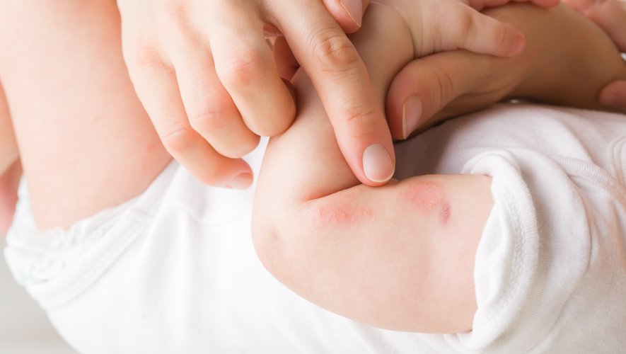 Eczéma du nourrisson : avancée de chercheurs toulousains