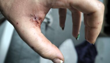 "Il tentait de lui arracher la mâchoire…" Cindy sauve courageusement son chien d’une attaque de pitbull, à Toulouse