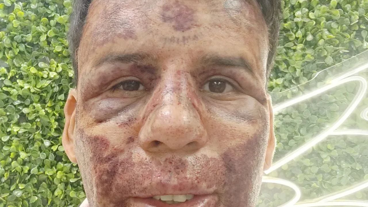 Leandro de Souza le visage gonflé