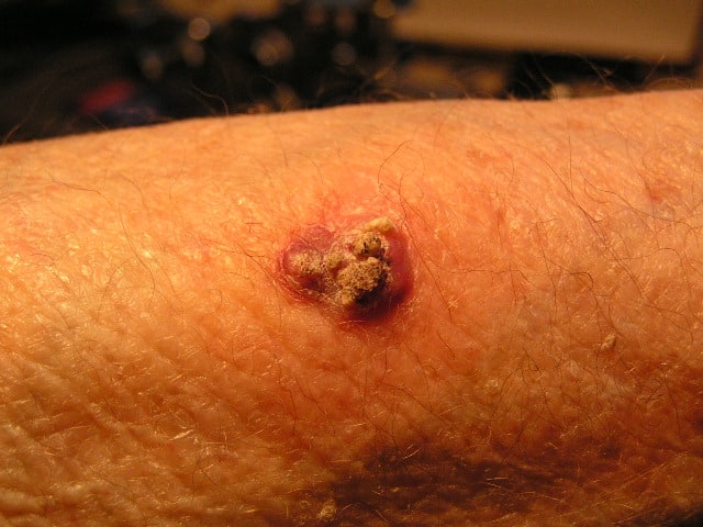 carcinome épidermoïde cutané