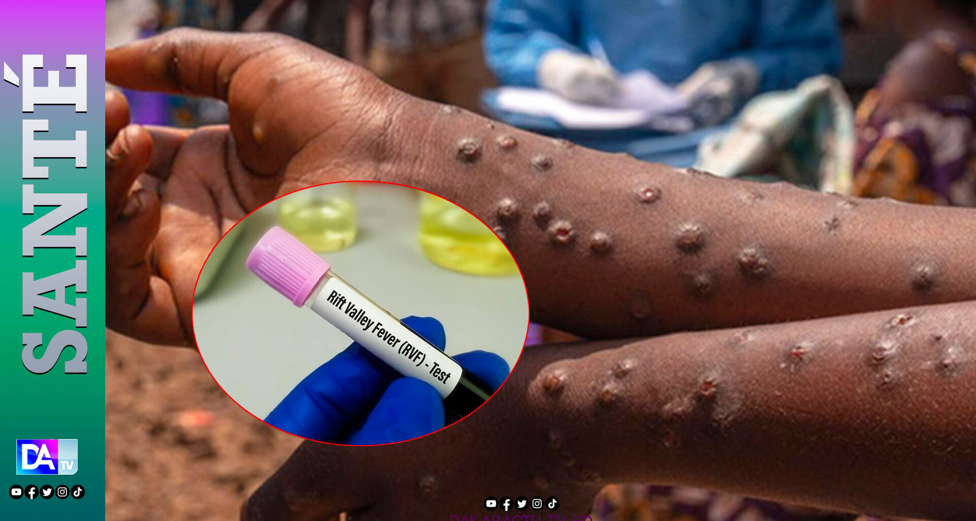 Le Sénégal face à deux épidémies simultanées : Mpox et Fièvre de la Vallée du Rift