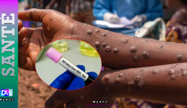 Le Sénégal face à deux épidémies simultanées : Mpox et Fièvre de la Vallée du Rift