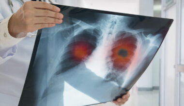 Santé. Pourquoi y a-t-il de plus en plus de cancer du poumon chez les non-fumeurs ?