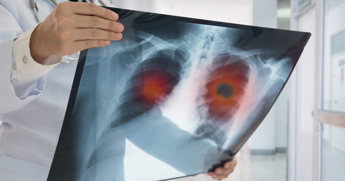 Santé. Pourquoi y a-t-il de plus en plus de cancer du poumon chez les non-fumeurs ?