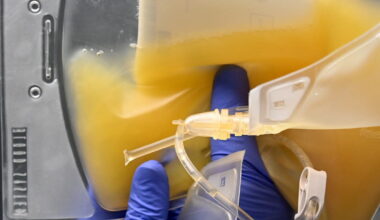 Saint-Étienne. Pourquoi faut-il collecter plus de plasma en France ?