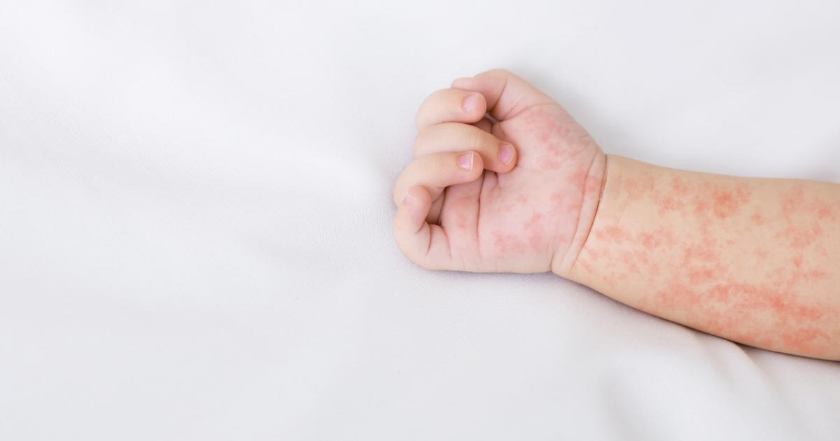 Au Canada, une épidémie de rougeole bien plus grave qu’aux États-Unis