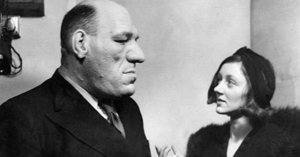 l’acromégalie, maladie qui fait grandir les membres et le visage