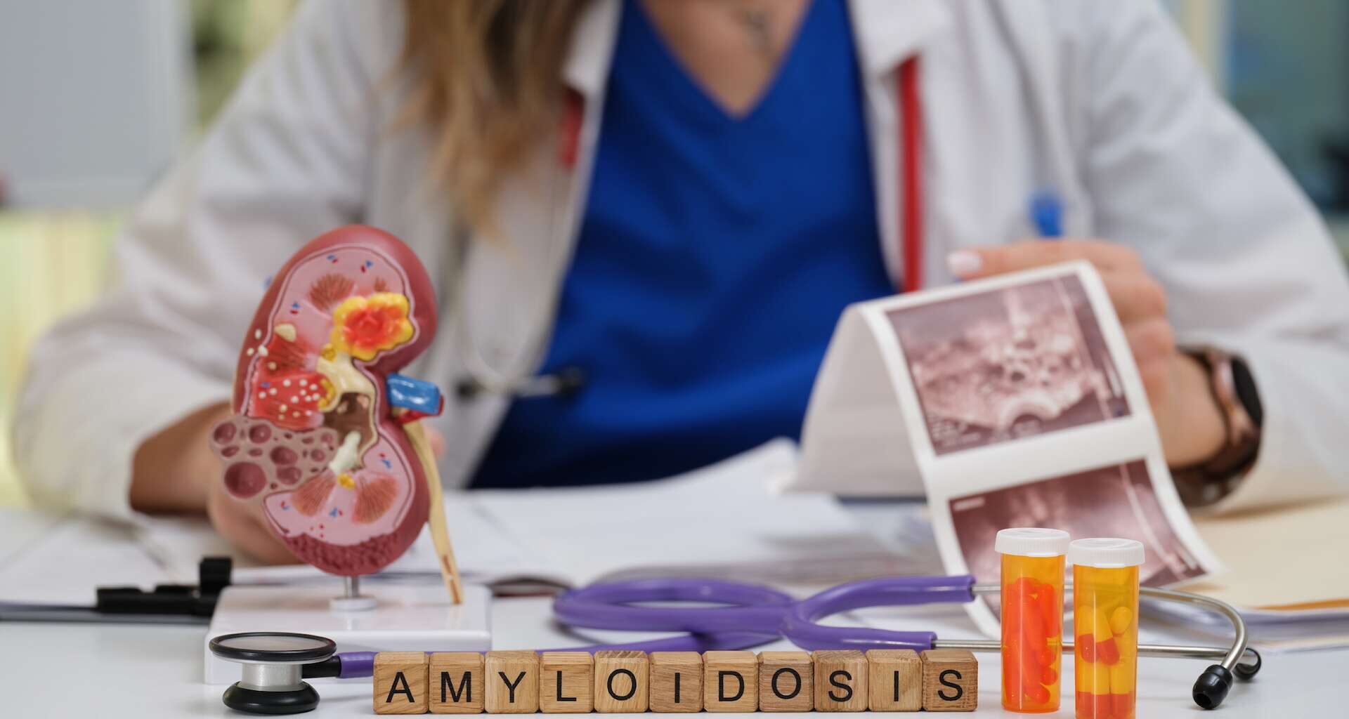 une avancée thérapeutique majeure contre l’amylose à transthyrétine (ATTR)