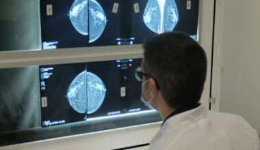 le dépistage du cancer du sein en net recul dans le Rhône
