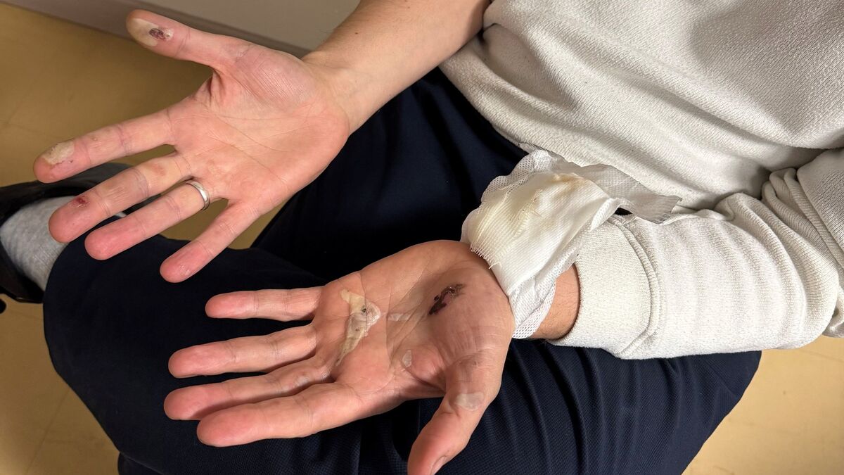 « J’ai vraiment eu peur » : gravement brûlé après l’explosion de sa batterie de cigarette électronique dans le RER