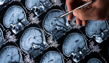 Cette molécule naturelle pourrait devenir une nouvelle arme contre Alzheimer