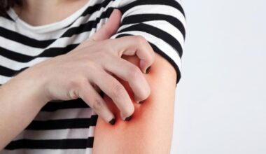 La fréquence de lavage n’aurait aucune incidence sur l’eczéma, selon une étude