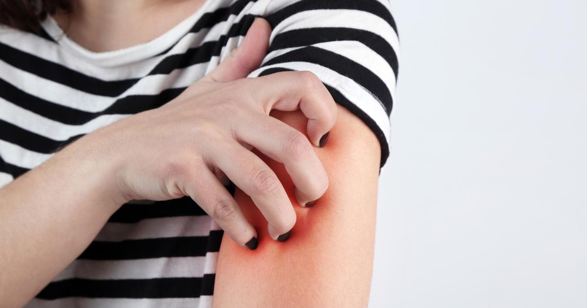 La fréquence de lavage n’aurait aucune incidence sur l’eczéma, selon une étude