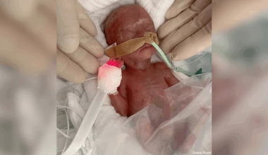 Allemagne : un bébé très grand prématuré sauvé contre toute attente - LINFO.re