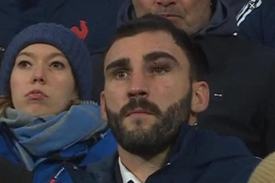 Un sacré cocard pour Charles Ollivon à l'œil gauche.