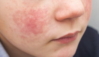 qu'est-ce que l'érythème infectieux, cette infection virale qui touche surtout les enfants ?