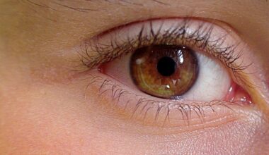 Son oeil a gonflé après un banal rhume : elle doit subir une opération du cerveau en urgence