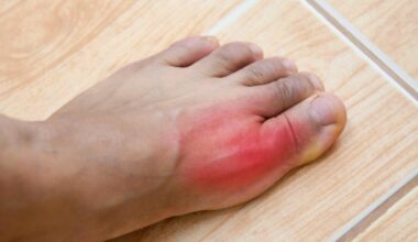 La goutte touche de plus en plus de jeunes: une hausse alarmante des cas