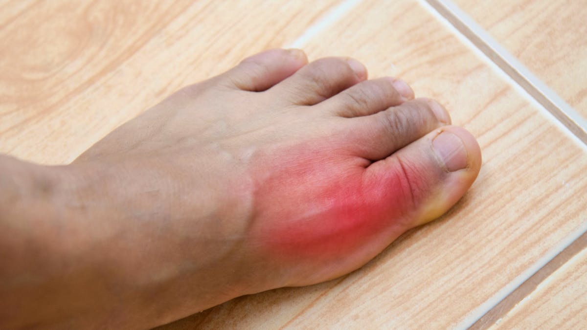 La goutte touche de plus en plus de jeunes: une hausse alarmante des cas