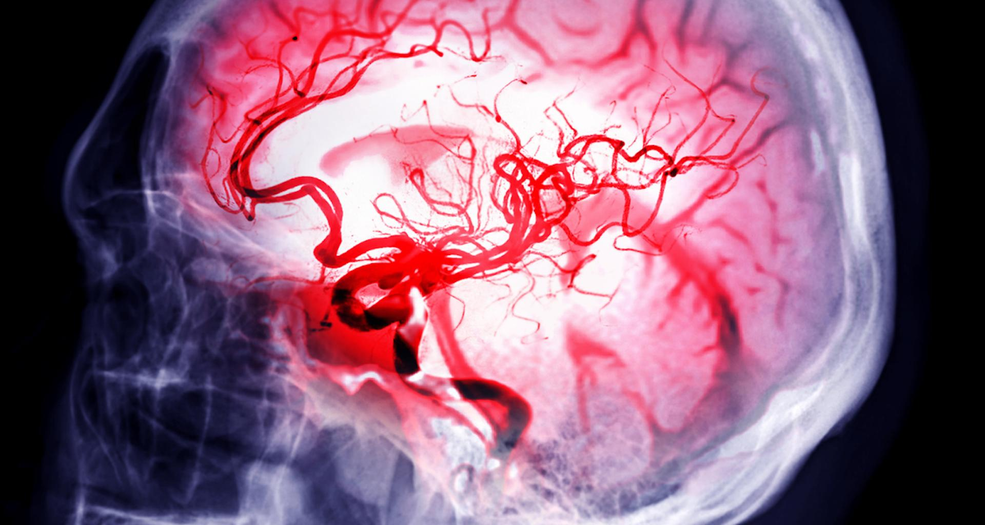 Cet étonnant traitement testé contre l’AVC bouleverse les premiers résultats