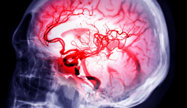 Cet étonnant traitement testé contre l’AVC bouleverse les premiers résultats