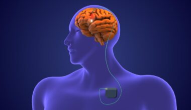 la stimulation cérébrale profonde « adaptative » améliore la vie des patients