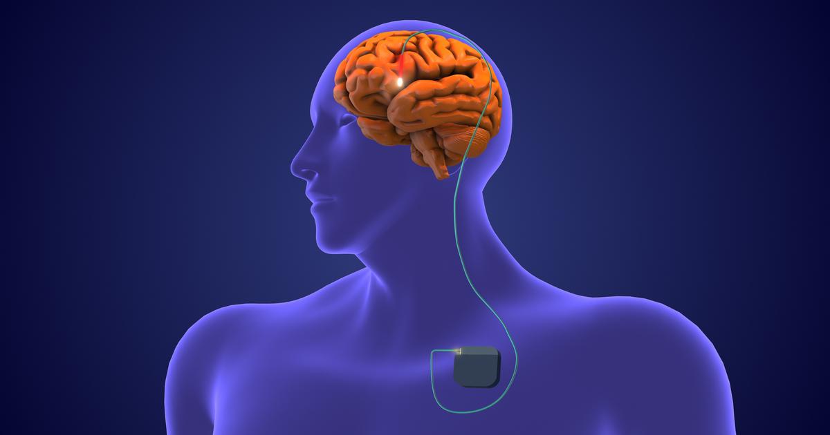 la stimulation cérébrale profonde « adaptative » améliore la vie des patients