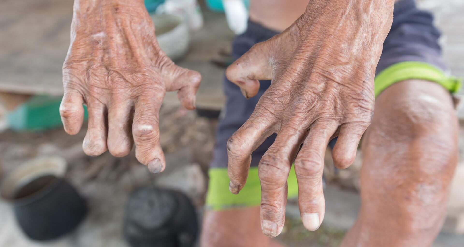 La lèpre est-elle de retour en Europe ?