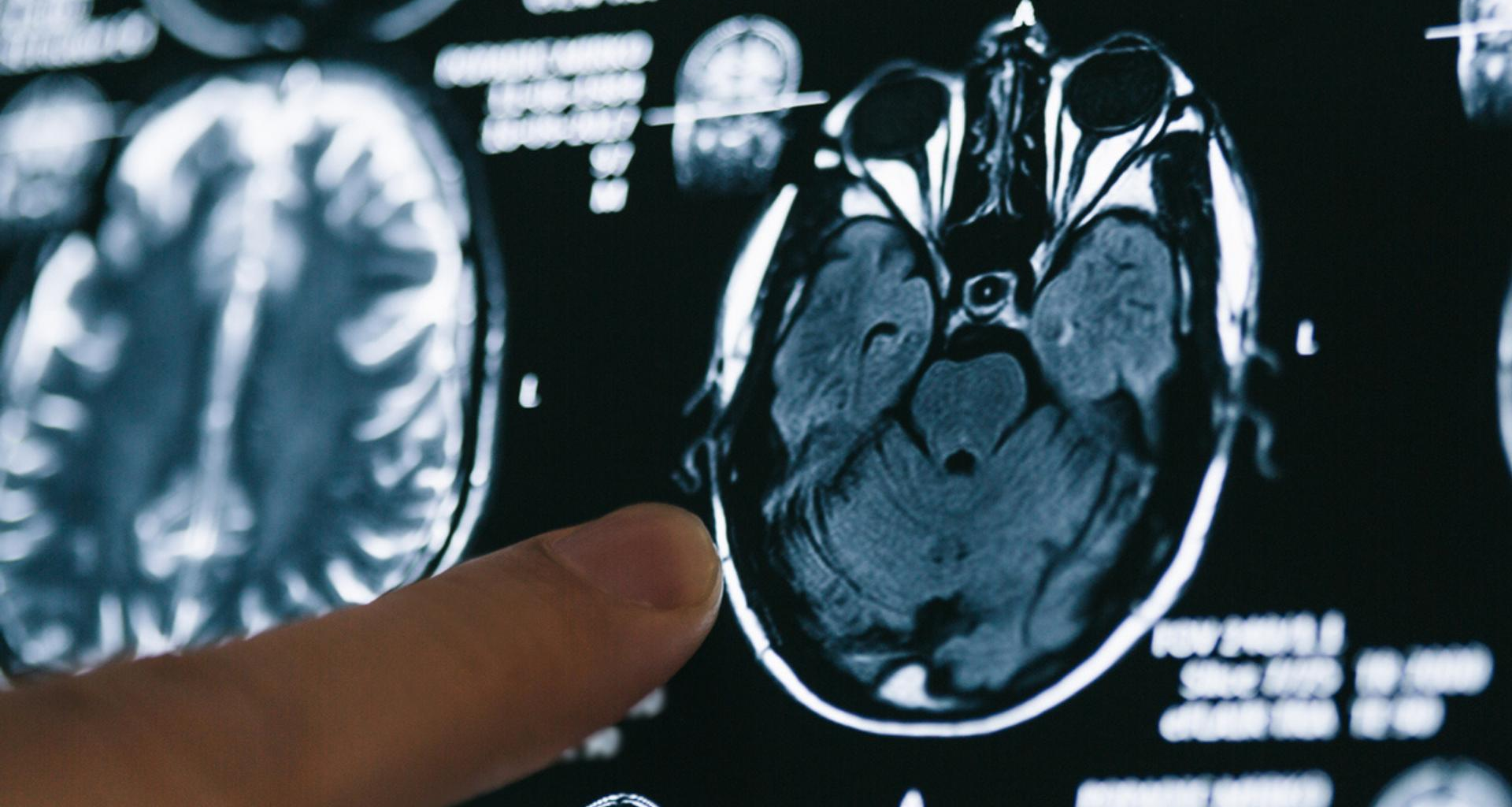 Ce cas unique d’Alzheimer force les chercheurs à tout revoir