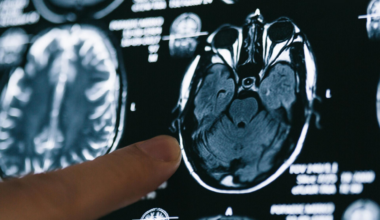 Ce cas unique d’Alzheimer force les chercheurs à tout revoir