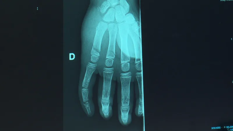 Une vingtaine d'opérations ont été nécessaires après des blessures dans les services SOS Main du CHU de Hautepierre et de la clinique Rhéna.