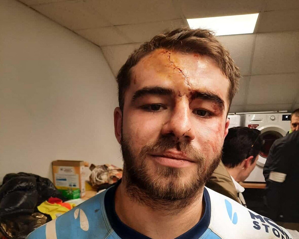 Un rugbyman s'ouvre le crâne pendant un match et se fait recoudre... par une gynécologue