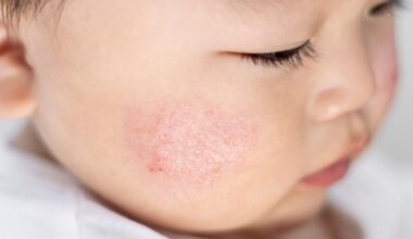 un circuit nerveux identifié comme déclencheur des poussées