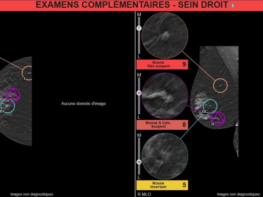de nice aux etats unis therapixel s impose dans le depistage du cancer du sein 3