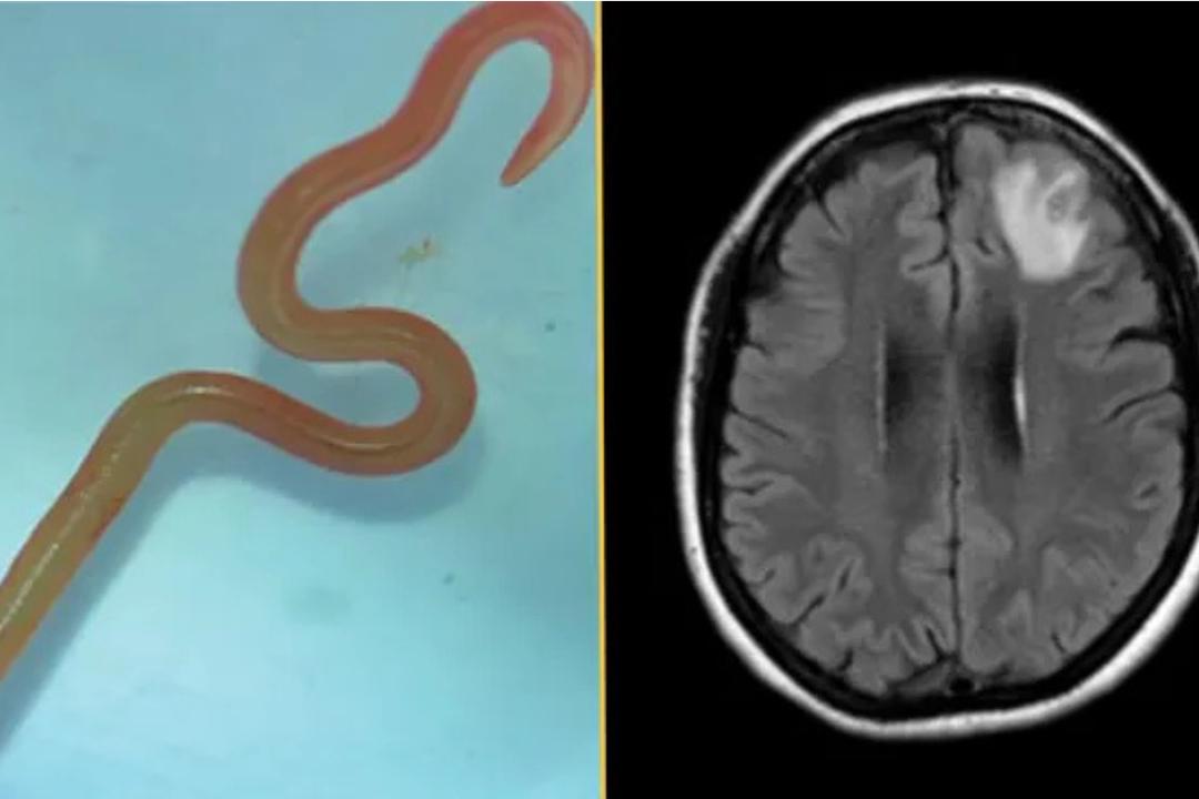 Lésions cérébrales et symptômes inexpliqués : les médecins découvrent un parasite inédit chez l’humain