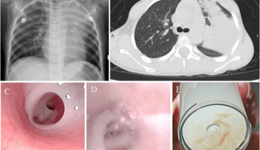 Intestinal necrosis due to nonocclusive mesenteric ischemia in a child with Mycoplasma pneumoniae pneumonia: a case report | BMC Infectious Diseases