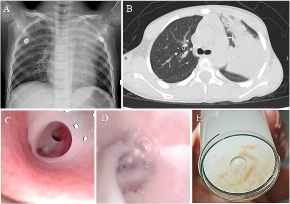 Intestinal necrosis due to nonocclusive mesenteric ischemia in a child with Mycoplasma pneumoniae pneumonia: a case report | BMC Infectious Diseases