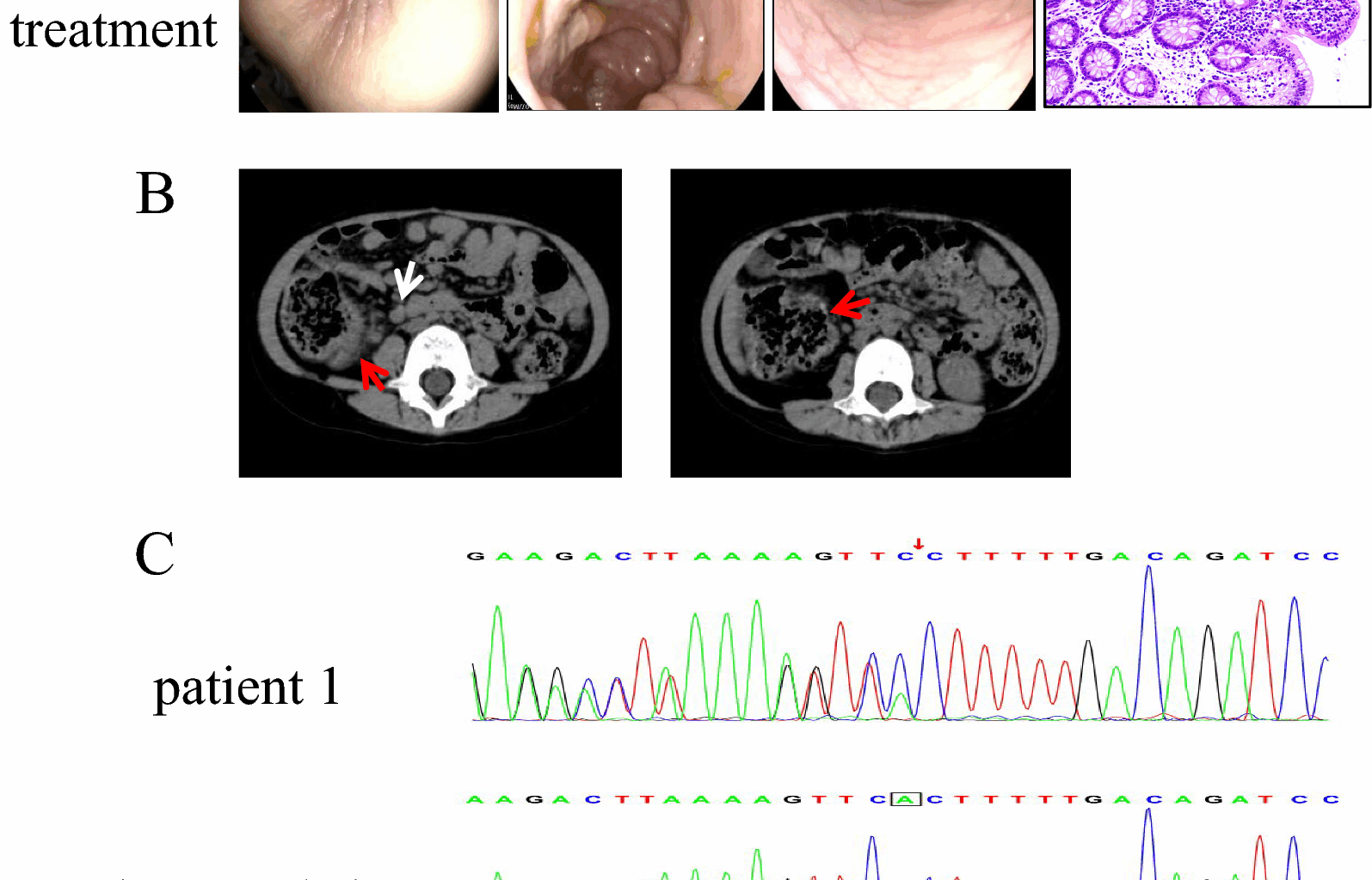 Clinical features and genetic analysis of A20 haploinsufficiency | Orphanet Journal of Rare Diseases