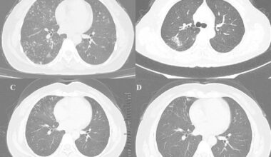 Mycobacterium hainanense sp. nov. represents an emerging nontuberculous Mycobacterium associated with chronic pulmonary disease
