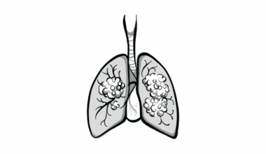 EBUS-TBNA Lung Biopsies Appear Safer, Adequate for Biomarker Testing