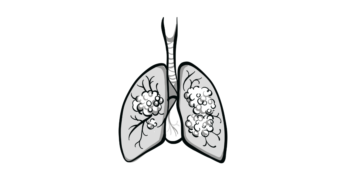 EBUS-TBNA Lung Biopsies Appear Safer, Adequate for Biomarker Testing