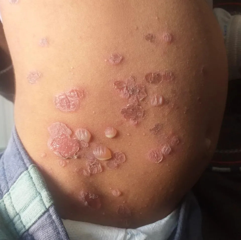 A young child suffers with Bullous Impetigo, a highly infectious bacterial skin disease characterised by large fluid-filled blisters