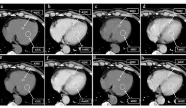 Should Chest CT be Routine for Prostate Cancer Patients on Androgen Deprivation Therapy?