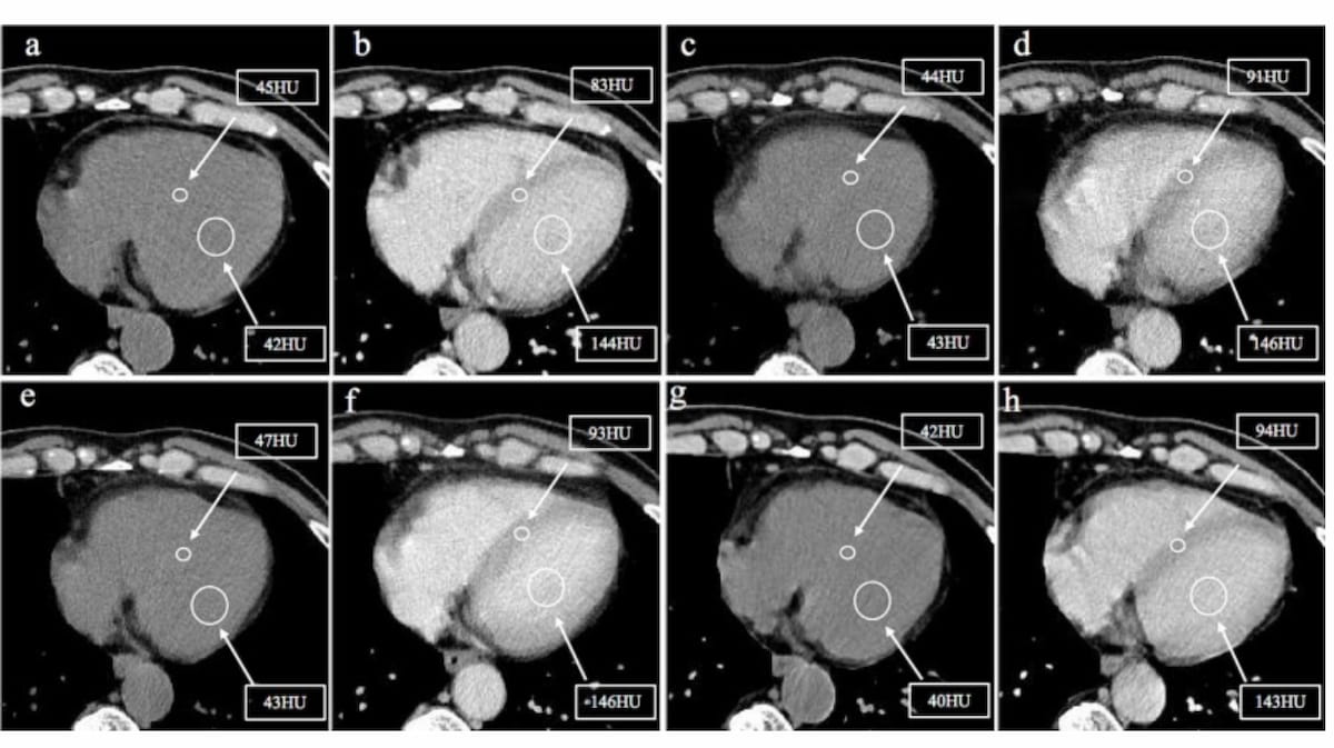 Should Chest CT be Routine for Prostate Cancer Patients on Androgen Deprivation Therapy?