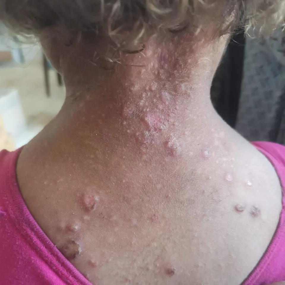 A young child suffers with scabies, a skin condition caused by tiny mites that burrow into the skin and cause an intense rash