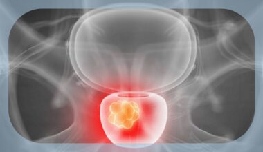 Observational Study Associates BRCA and Other HRR Gene Alterations With Poorer Outcomes in mHSPC