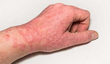 GLP-1s Cut CV Risks Tied to Type 2 Diabetes and AD